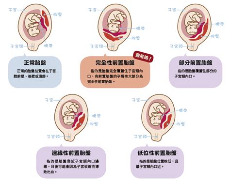 前置胎盤剝離|胎盤早期剝離